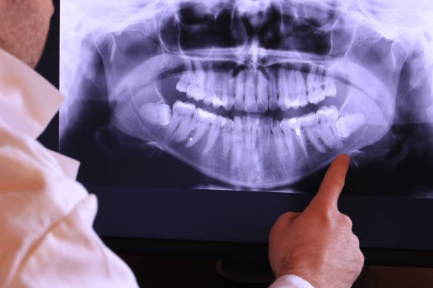 Best Emergency Wisdom Teeth Removal in Lowell, MI